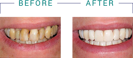 Tiba Dental | Implant Dentistry, Extractions and Orthodontics