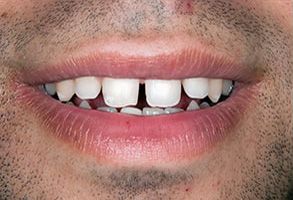 Tiba Dental | Teeth Whitening, Invisalign reg  and Orthodontics